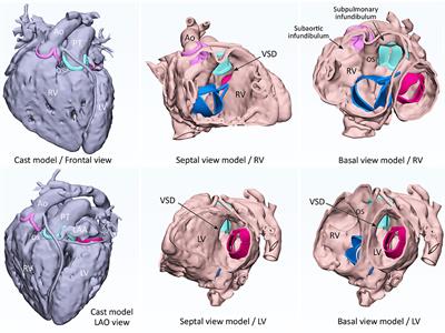 3D Modeling and Printing in Congenital Heart Surgery: Entering the Stage of Maturation